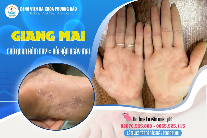 CẢNH BÁO: PHÁT HIỆN TRƯỜNG HỢP GIANG MAI TẠI BVĐK PHƯƠNG BẮC – CĂN BỆNH NGUY HIỂM ÂM THẦM LÂY LAN