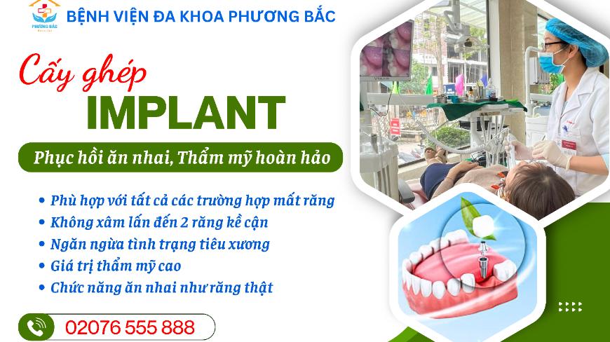 CẤY GHÉP IMPLANT – PHỤC HỒI ĂN NHAI, THẨM MỸ HOÀN HẢO