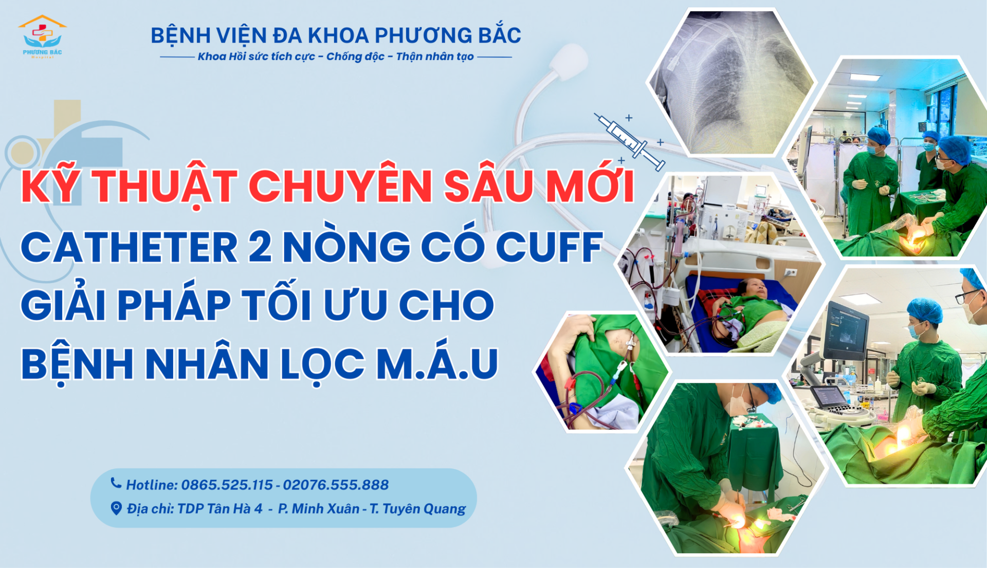 KỸ THUẬT CHUYÊN SÂU MỚI: CATHETER 2 NÒNG CÓ CUFF - GIẢI PHÁP TỐI ƯU CHO BỆNH NHÂN LỌC M.Á.U