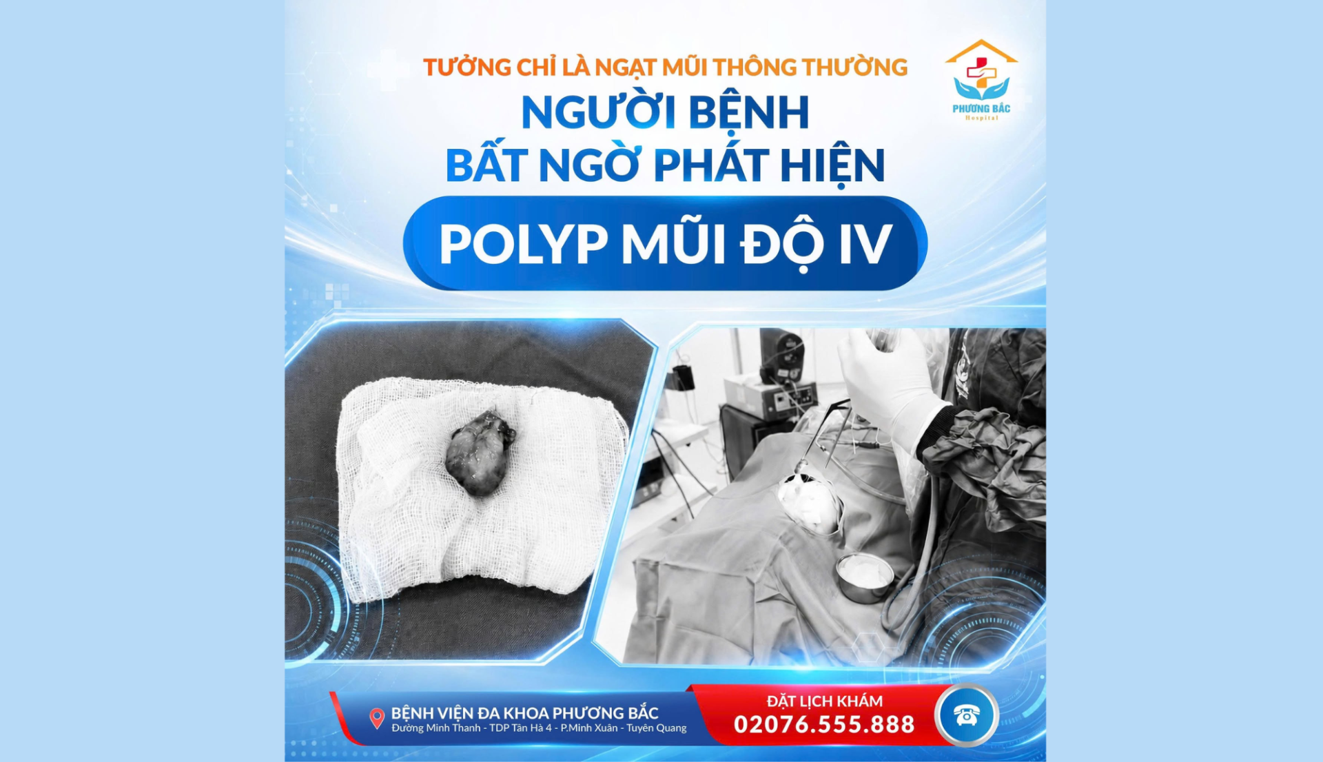 TƯỞNG CHỈ LÀ NGẠT MŨI THÔNG THƯỜNG, NGƯỜI BỆNH BẤT NGỜ PHÁT HIỆN POLYP MŨI ĐỘ IV