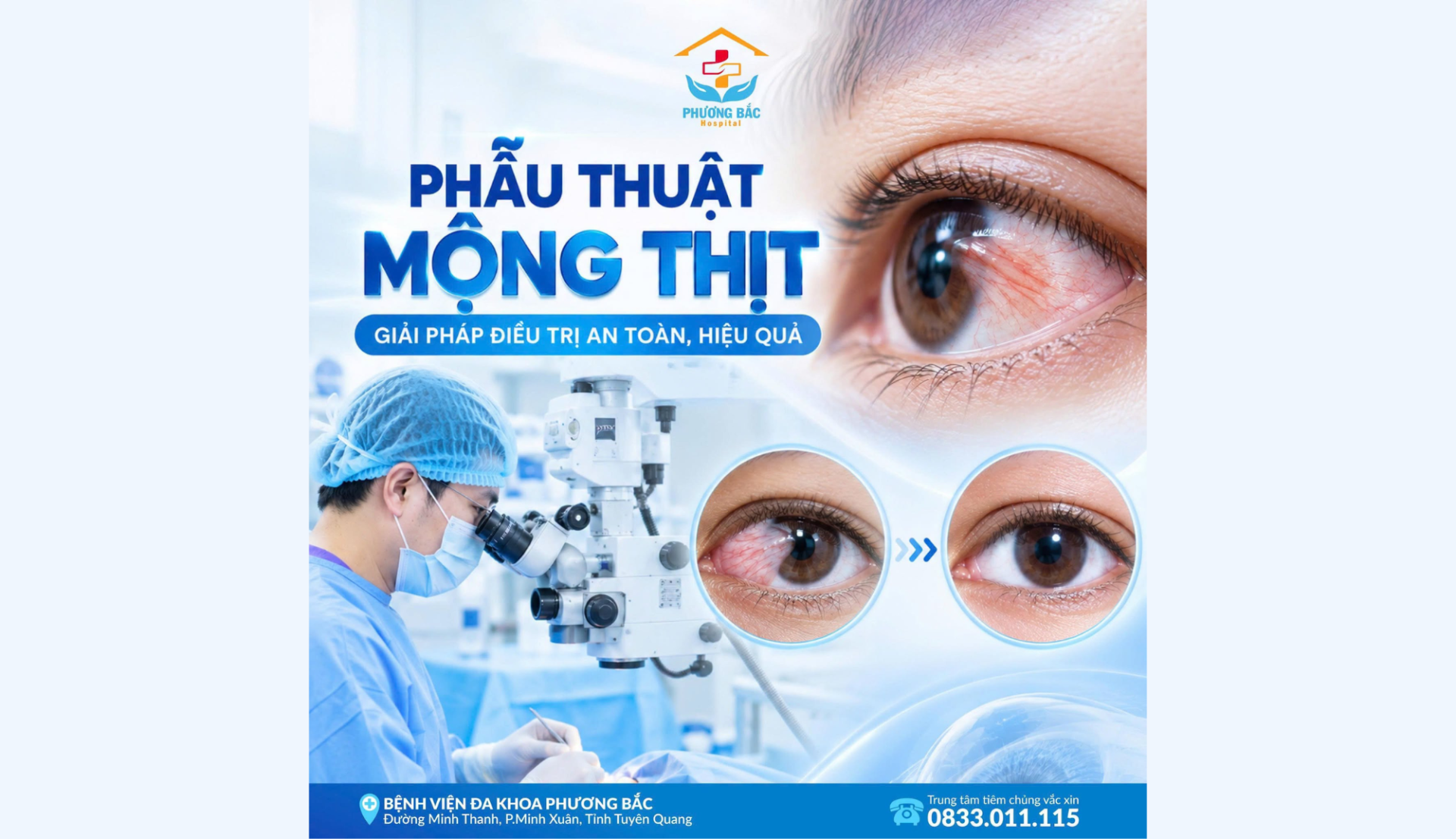 PHẪU THUẬT MỘNG THỊT – GIẢI PHÁP ĐIỀU TRỊ AN TOÀN, HIỆU QUẢ TẠI BVĐK PHƯƠNG BẮC