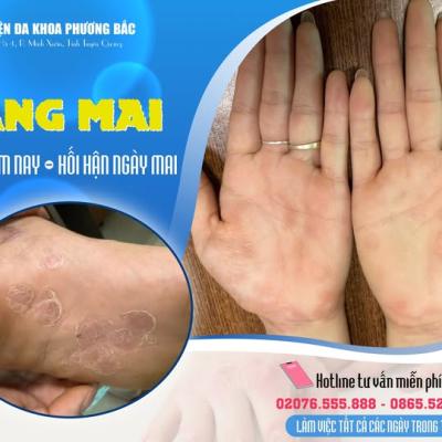CẢNH BÁO: PHÁT HIỆN TRƯỜNG HỢP GIANG MAI TẠI BVĐK PHƯƠNG BẮC – CĂN BỆNH NGUY HIỂM ÂM THẦM LÂY LAN